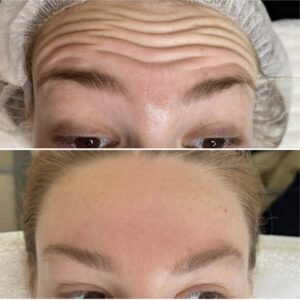 botox vrásky mračenia